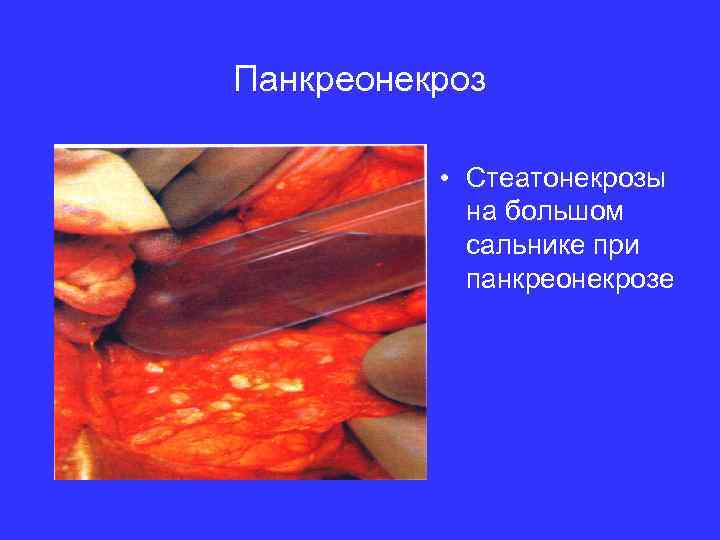 Панкреонекроз • Стеатонекрозы на большом сальнике при панкреонекрозе 