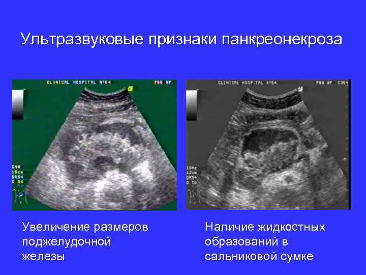 Ультразвуковые признаки панкреонекроза Увеличение размеров поджелудочной железы Наличие жидкостных образований в сальниковой сумке 