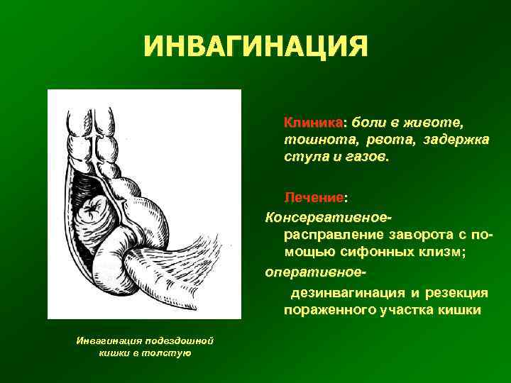 ИНВАГИНАЦИЯ Клиника: боли в животе, тошнота, рвота, задержка стула и газов. Лечение: Консервативное расправление