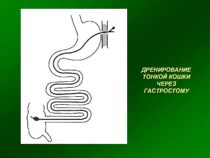 ДРЕНИРОВАНИЕ ТОНКОЙ КОШКИ ЧЕРЕЗ ГАСТРОСТОМУ 