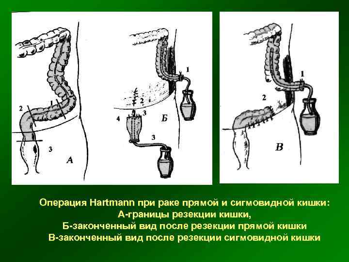 Операция Hartmann при раке прямой и сигмовидной кишки: А-границы резекции кишки, Б-законченный вид после