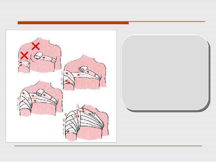 Повязка накладывается средним бинтом (7 -10 см). 