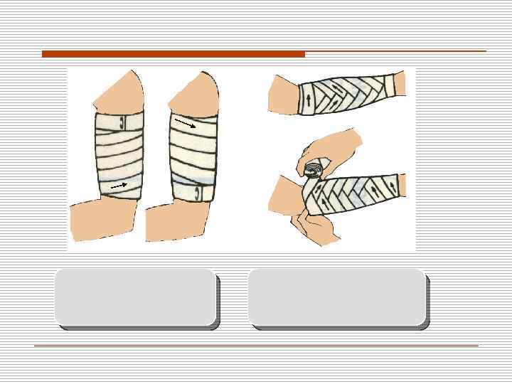Повязка накладывается узким бинтом (5 см). 