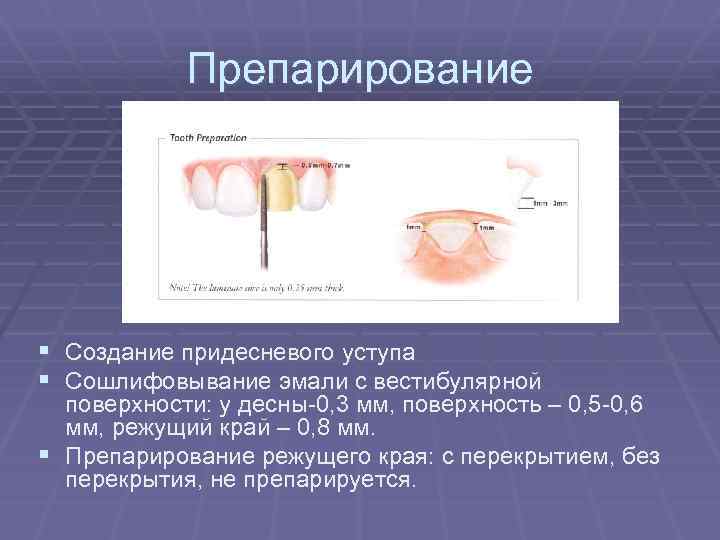 Препарирование § Создание придесневого уступа § Сошлифовывание эмали с вестибулярной поверхности: у десны-0, 3
