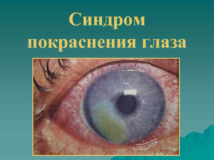 Синдром покраснения глаза 