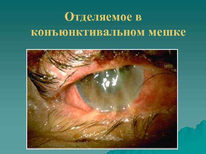Отделяемое в конъюнктивальном мешке 