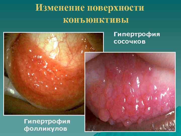 Изменение поверхности конъюнктивы Гипертрофия сосочков г Гипертрофия фолликулов 