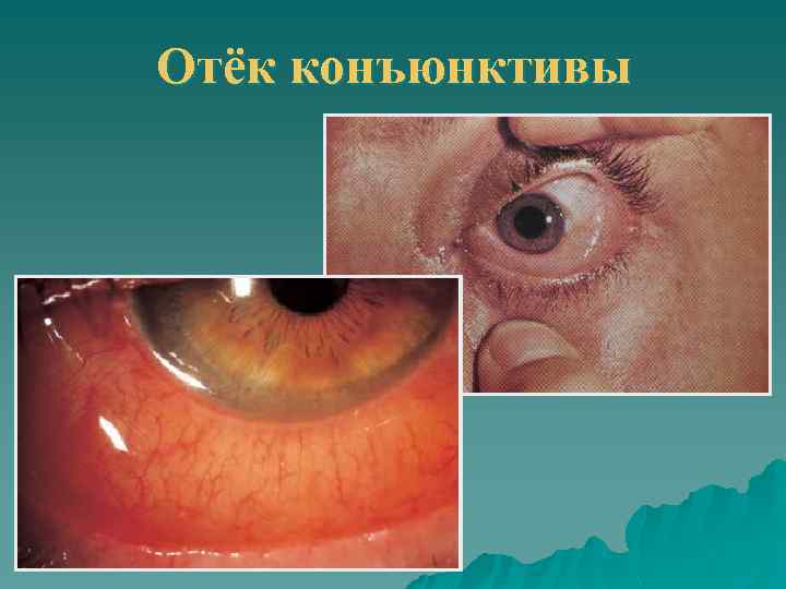 Отёк конъюнктивы 
