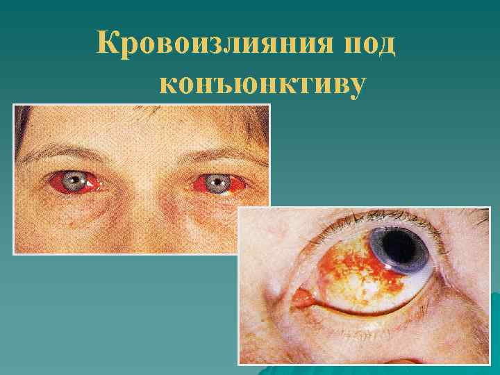 Кровоизлияния под конъюнктиву 