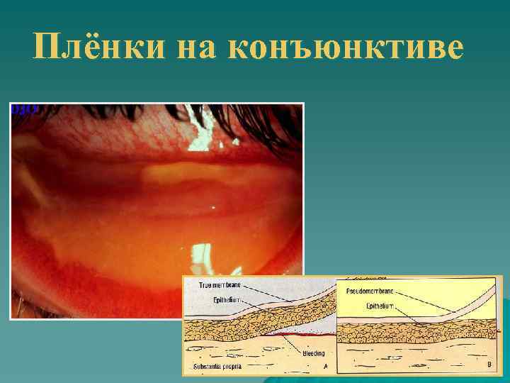 Плёнки на конъюнктиве 