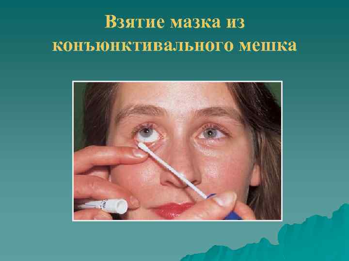 Взятие мазка из конъюнктивального мешка 