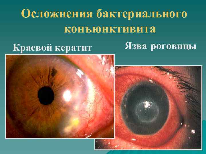 Осложнения бактериального конъюнктивита Краевой кератит Язва роговицы 