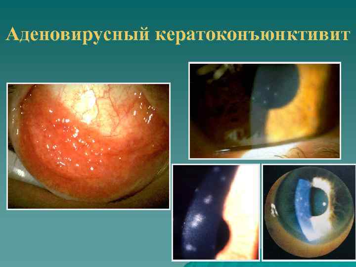 Аденовирусный кератоконъюнктивит 