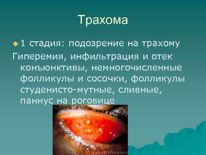 Трахома u 1 стадия: подозрение на трахому Гиперемия, инфильтрация и отек конъюнктивы, немногочисленные фолликулы