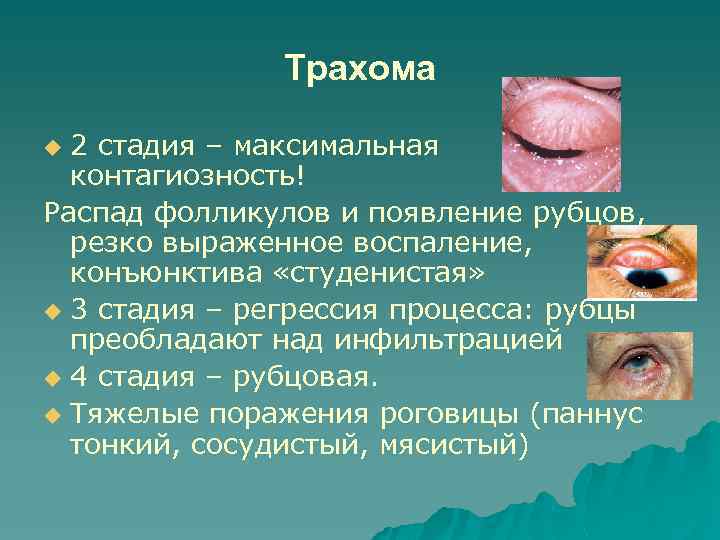 Трахома 2 стадия – максимальная контагиозность! Распад фолликулов и появление рубцов, резко выраженное воспаление,