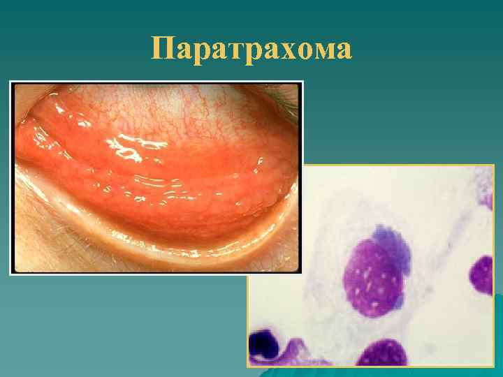 Паратрахома 
