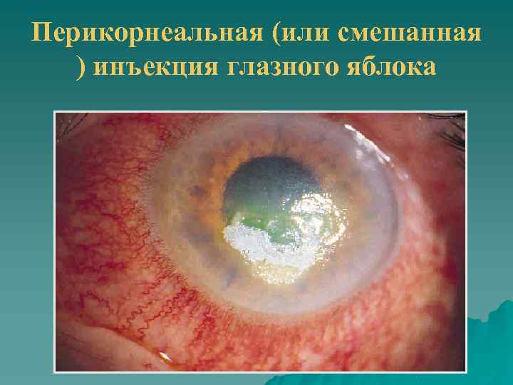 Перикорнеальная (или смешанная ) инъекция глазного яблока 