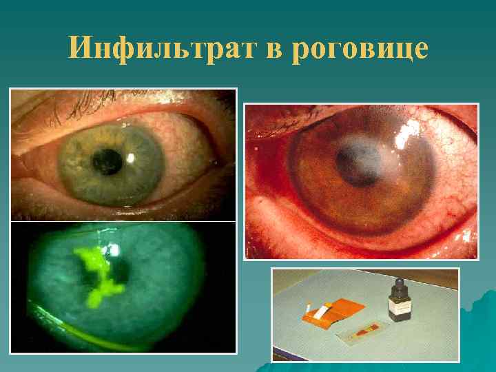 Инфильтрат в роговице 
