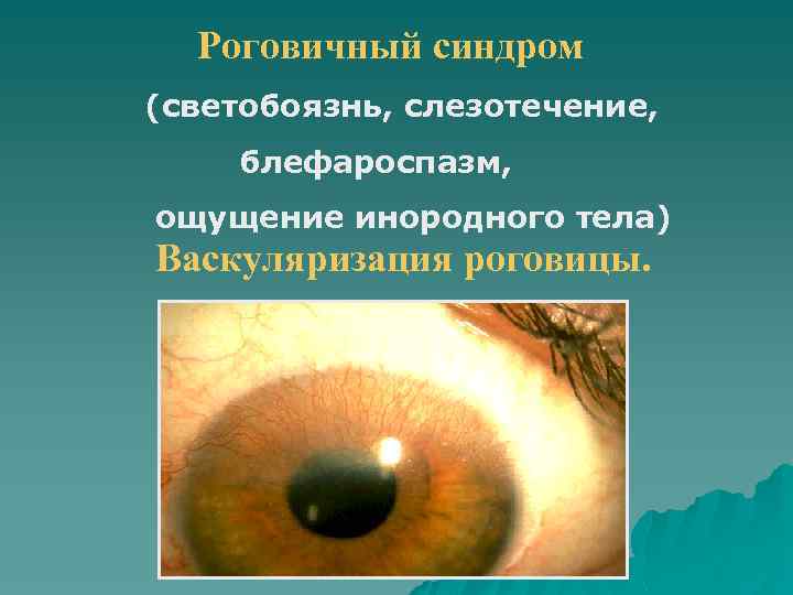 Роговичный синдром (светобоязнь, слезотечение, блефароспазм, ощущение инородного тела) Васкуляризация роговицы. 