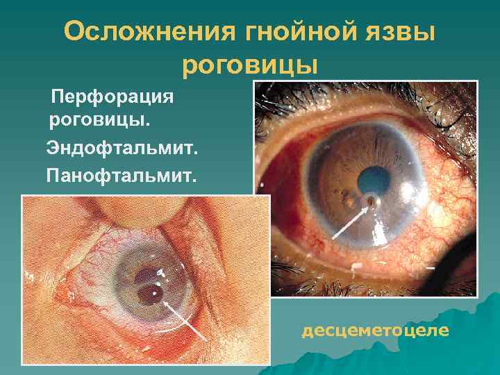 Осложнения гнойной язвы роговицы Перфорация роговицы. Эндофтальмит. Панофтальмит. десцеметоцеле 