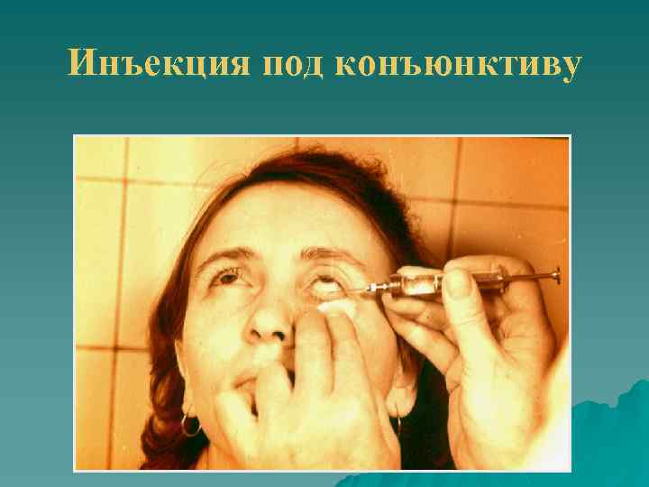 Инъекция под конъюнктиву 