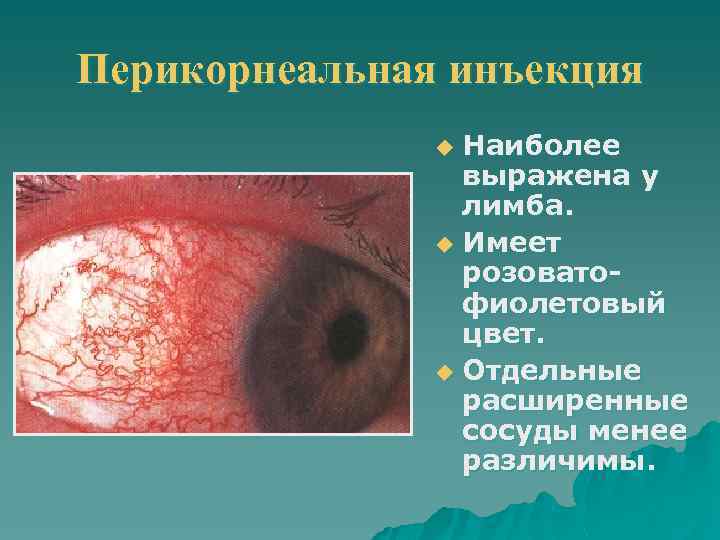 Перикорнеальная инъекция Наиболее выражена у лимба. u Имеет розоватофиолетовый цвет. u Отдельные расширенные сосуды