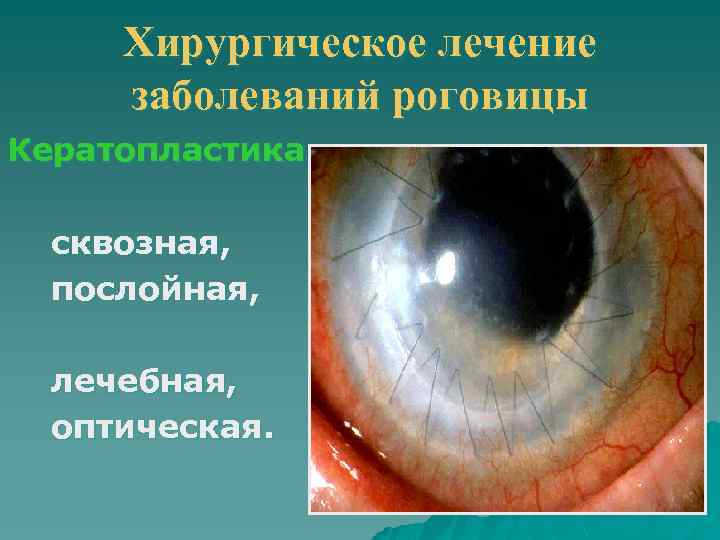 Хирургическое лечение заболеваний роговицы Кератопластика сквозная, послойная, лечебная, оптическая. 