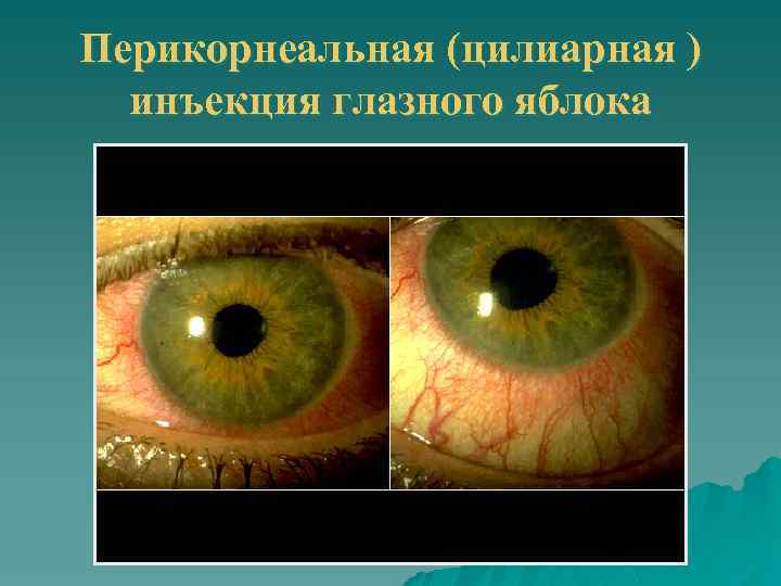 Перикорнеальная (цилиарная ) инъекция глазного яблока 