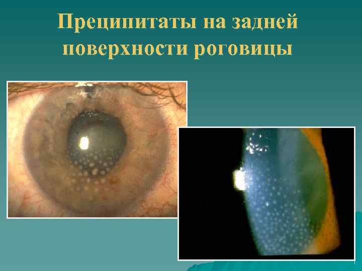 Преципитаты на задней поверхности роговицы 