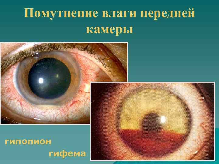 Помутнение влаги передней камеры гипопион гифема 