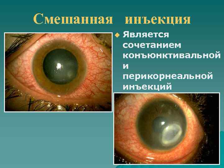 Смешанная инъекция u Является сочетанием конъюнктивальной и перикорнеальной инъекций 