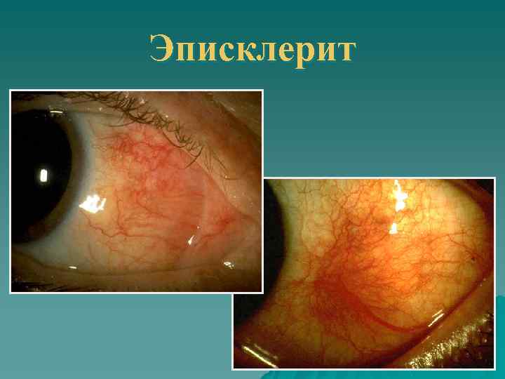 Эписклерит 