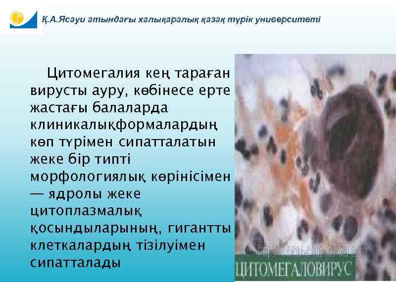 Қ. А. Ясауи атындағы халықаралық қазақ түрік университеті Цитомегалия кең тараған вирусты ауру, көбінесе