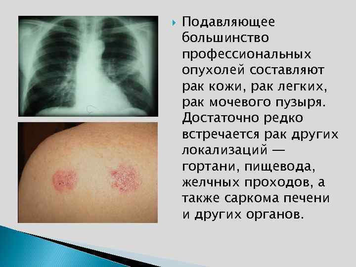 Подавляющее большинство профессиональных опухолей составляют рак кожи, рак легких, рак мочевого пузыря. Достаточно
