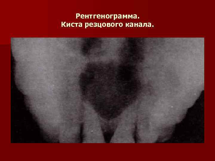 Рентгенограмма. Киста резцового канала. 