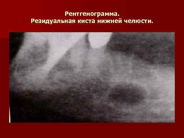 Рентгенограмма. Резидуальная киста нижней челюсти. 