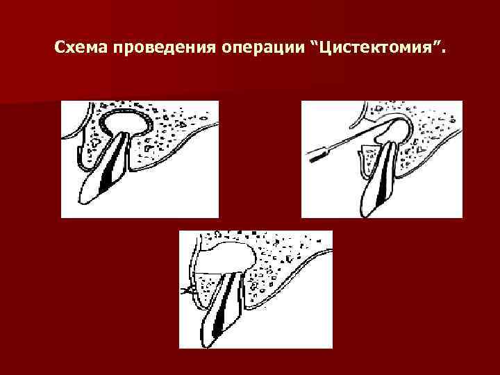 Схема проведения операции “Цистектомия”. 