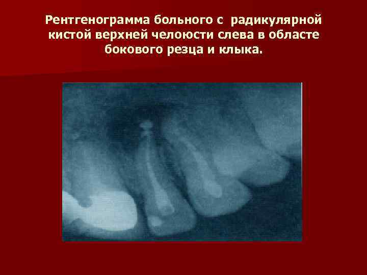 Рентгенограмма больного с радикулярной кистой верхней челоюсти слева в областе бокового резца и клыка.