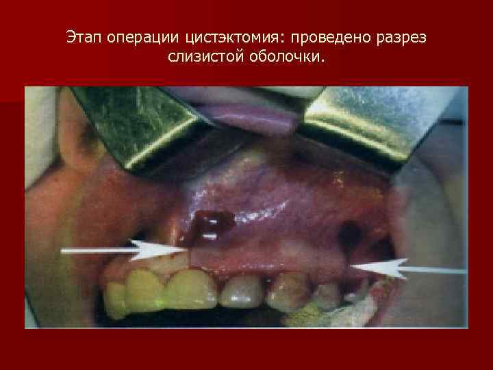 Этап операции цистэктомия: проведено разрез слизистой оболочки. 