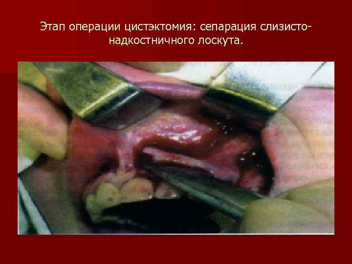 Этап операции цистэктомия: сепарация слизистонадкостничного лоскута. 