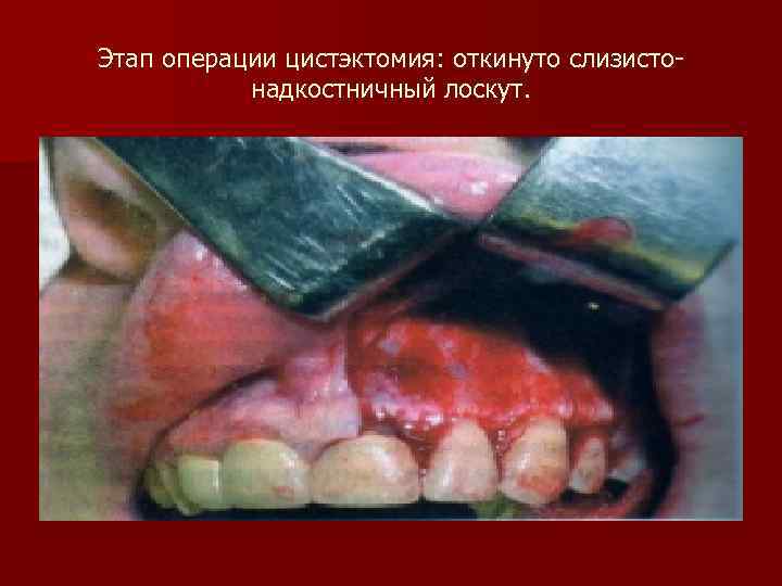 Этап операции цистэктомия: откинуто слизистонадкостничный лоскут. 