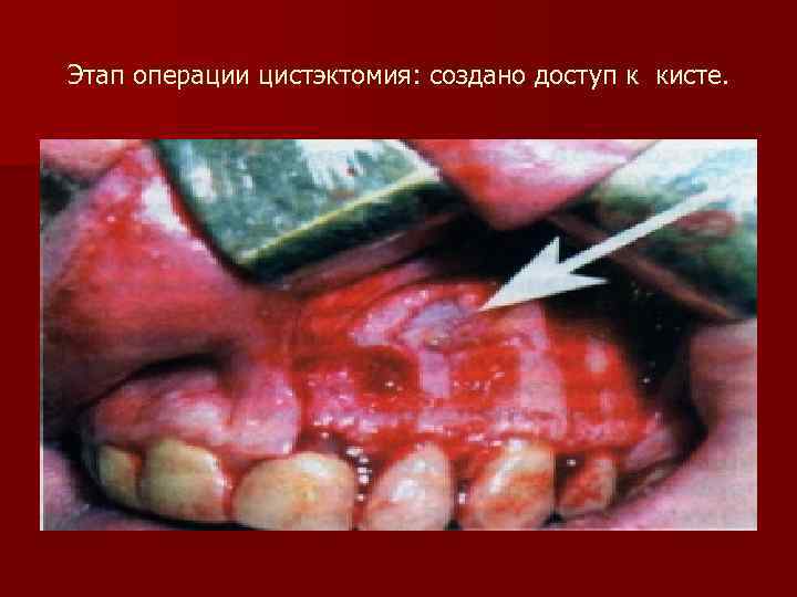 Этап операции цистэктомия: создано доступ к кисте. 