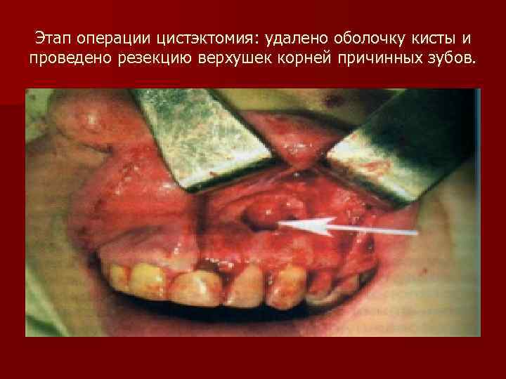 Этап операции цистэктомия: удалено оболочку кисты и проведено резекцию верхушек корней причинных зубов. 