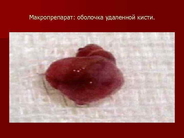 Макропрепарат: оболочка удаленной кисти. 