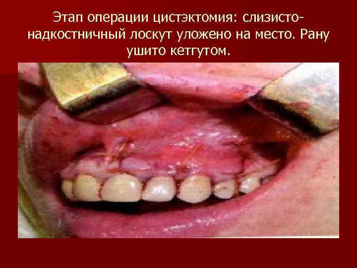 Этап операции цистэктомия: слизистонадкостничный лоскут уложено на место. Рану ушито кетгутом. 