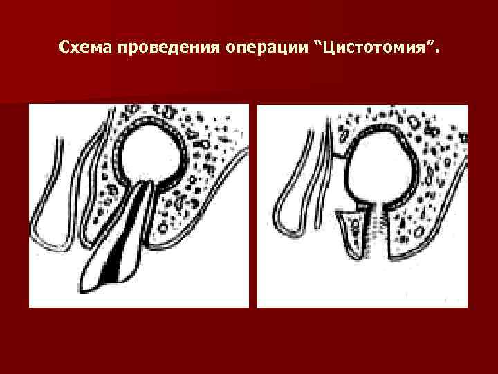 Схема проведения операции “Цистотомия”. 