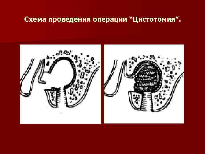 Схема проведения операции “Цистотомия”. 