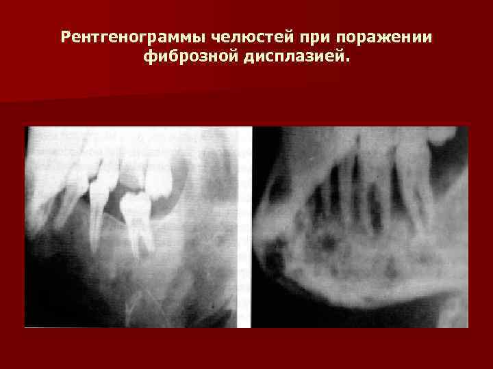 Рентгенограммы челюстей при поражении фиброзной дисплазией. 