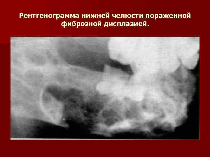 Рентгенограмма нижней челюсти пораженной фиброзной дисплазией. 