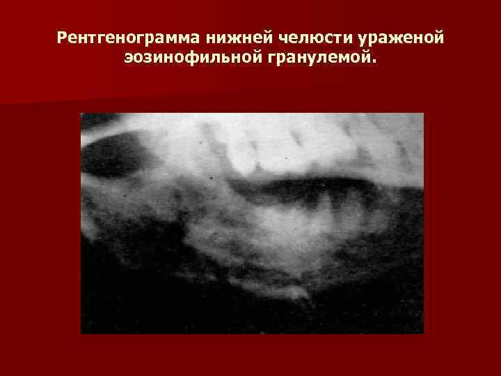 Рентгенограмма нижней челюсти ураженой эозинофильной гранулемой. 
